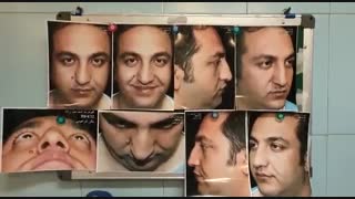 اصلاح کجی بینی گوشتی | جراح بینی تهران دکتر ابراهیمی