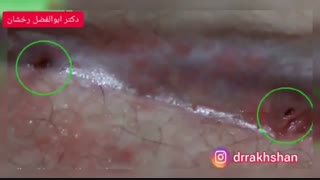 انیمیشن کیست مویی