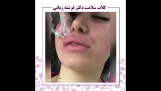 متقارن سازی لب با ژل
