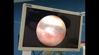 آندوسکوپی مغز در بطن سوم در هیدروسفالی