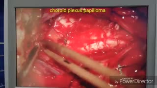 تومور بزرگ بطن چهارم با تاری دید و عدم تعادل