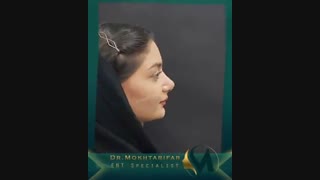 فیلم نتیجه عمل بینی حدود یک ماه پس از جراحی زیبایی بینی