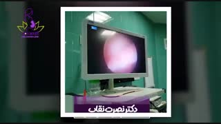 فیلم برداشت فیبروم رحمی با هیستروسکوپی قبل از انتقال جنین