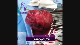 فیلم جراحی میومکتومی