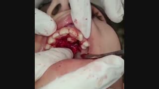 جراحی دندان نیش نهفته