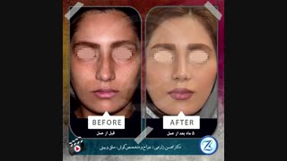 جراحی بینی ( 5 ماه بعد از عمل)