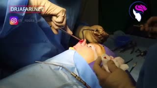 فیلم واقعی جراحی سپتورینوپلاستی خانمی 27 ساله