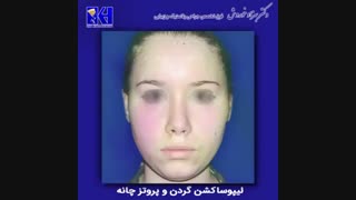فیلم همزمان لیپوساکشن گردن و پروتز چانه