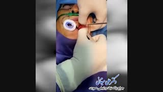 فیلم تخلیه ژل صورت