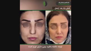 جراحی بینی طبیعی در بینی کوتاه و گوشتی | دکتر باستانی نژاد | جراح بینی