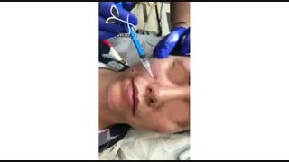 مزوتراپی پوست صورت