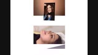 فیلم واقعی نمونه کار جراحی بینی گوشتی بعد از 1 سال