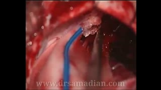 جراحی تومور شوانوم CPA بزرگ