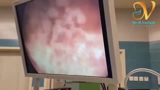 فیلم عمل آندوسکوپی کلیه با روش pcnl