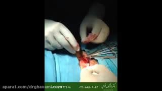 عمل جراحی واریکوسل در مردان