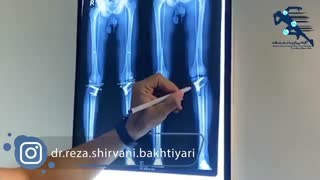 تشخیص زانوی پرانتزی