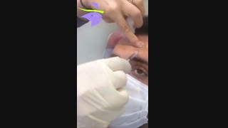 فیلم تزریق بوتاکس به پیشانی کامپوزیت ونیر