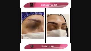 فیلم واقعی قبل و بعد کاشت ابرو با طراحی طبیعی