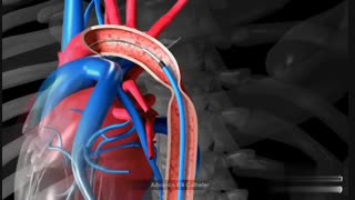 استنت  گذاری کوارکتاسیون آئورت