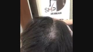 اسکالپ | میکرو اسکالپ | تاتو سر