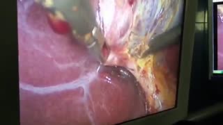 رابطه سنگ صفرا با جراحی های چاقی