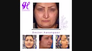 جراحی بینی انجام شده توسط دکتر مسعود حسن پور