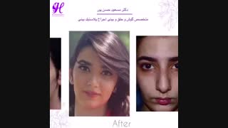 نتیجه جراحی بینی بعد از 9 ماه