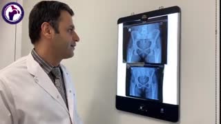 درمان شکستگی لگن تعویض مفصل نیست