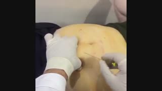 امبدینگ نخ روی چاقی | 02122853829