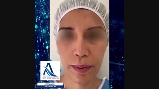 فیلم تزریق چربی به صورت جراحی فک