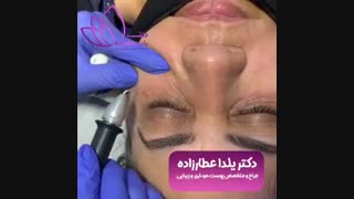 فیلم از بین بردن چروک زیر چشم با پلاسما جت لیپوست