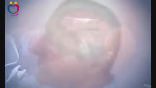 آلزایمر