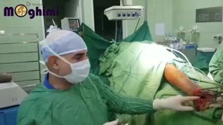 فیلم عمل جراحی شکستگی داخل مفصلی پاشنه پا