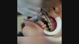 ارتودنسی سرامیکی