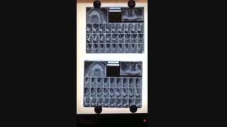 انجام 15 واحد ایمپلنت