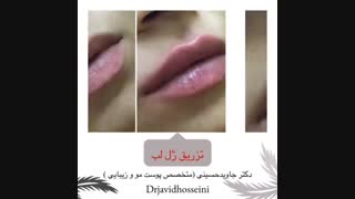 فیلم تزریق ژل لب