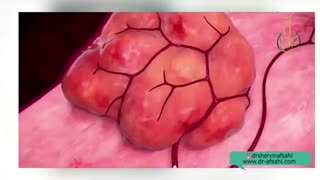 فیلم خارج کردن فیبروم از رحم