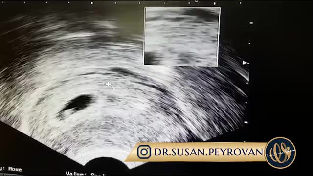 فیلم سونوگرافی هفته هفتم بارداری