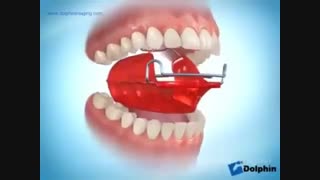 پلاک ارتودنسی اطفال
