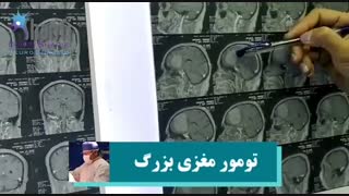تومور بزرگ در مغز در خانم 70 ساله