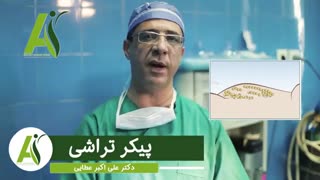 تفاوت ابدومینوپلاستی و لیپو