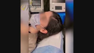 درمان ریزش مو بر اثر پلی کیستیک تخمدان و درمان دارویی و همراه با مزوتراپی