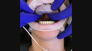 روکش موقت-www.pardisdental.ir