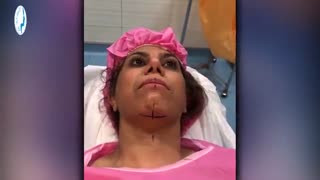 جراحی پروتز چانه توسط دکتر محمد گلی ، متخصص گوش و حلق و بینی