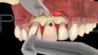 پوسیدگی زیر لثه