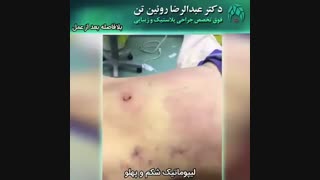 لیپوماتیک شکم و پهلو توسط دکتر عبدالرضا روئین تن فوق تخصص جراحی پلاستیک
