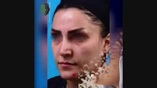 هشت ماه بعد از جراحی زیبایی بینی اولیه | دکتر باستانی نژاد