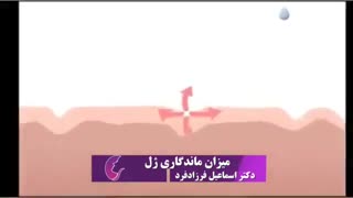 میزان ماندگاری ژل چقدر است؟ آکنه