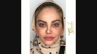 تزریق ژل به لب
