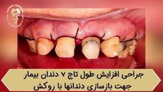 فیلم واقعی جراحی افزایش طول دندان